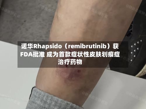 诺华Rhapsido(remibrutinib)获FDA批准 成为首款症状性皮肤划痕症治疗药物-第2张图片